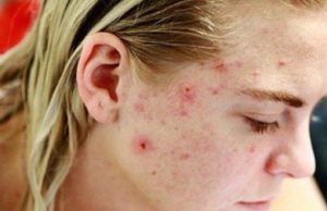 Svi ga imamo u kući: Uklanja bradavice i akne, rješava upalu grla, perut…